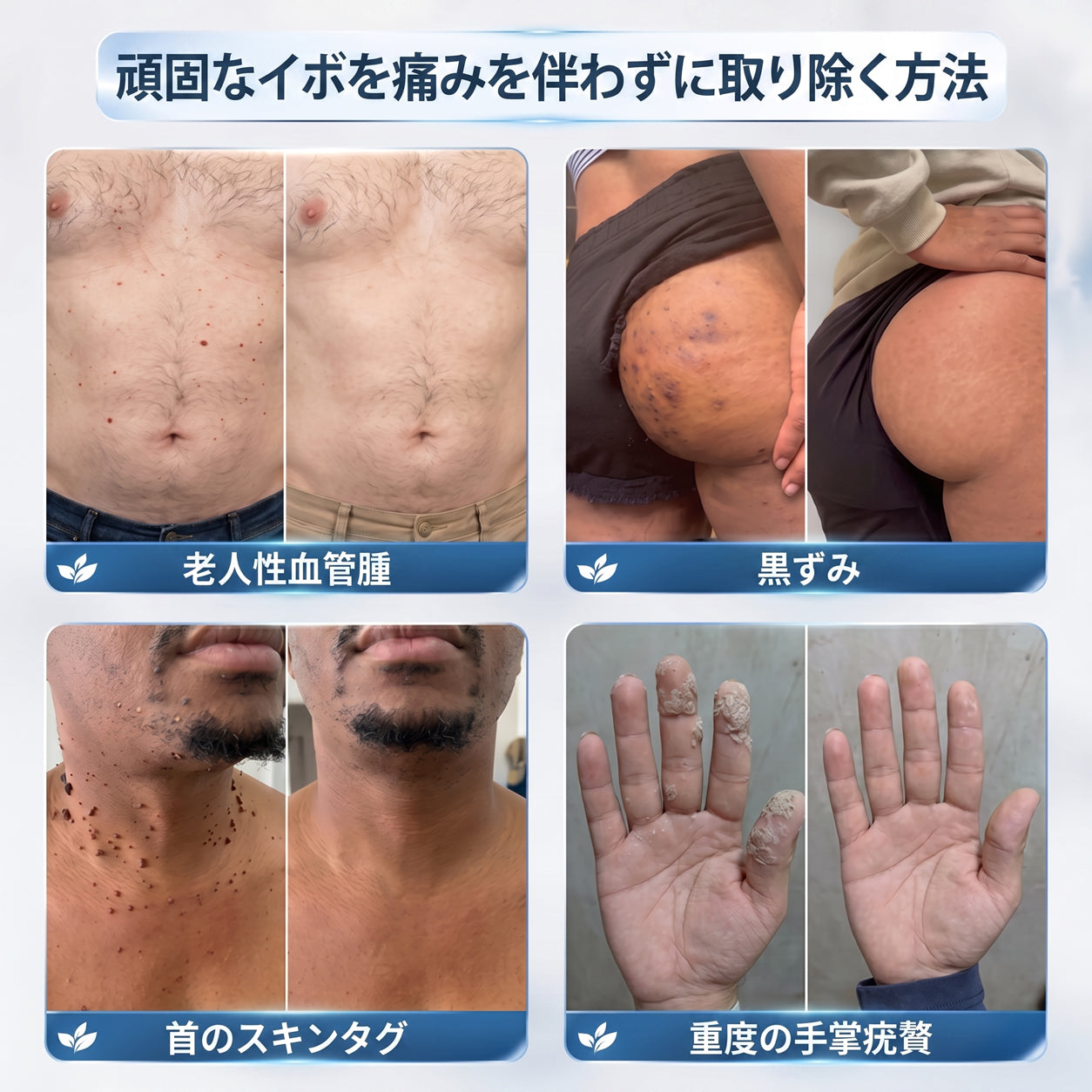 ✨追加ケアがお得！30%OFF💕 Hiskin® タグ＆スポットイレーサー🪄