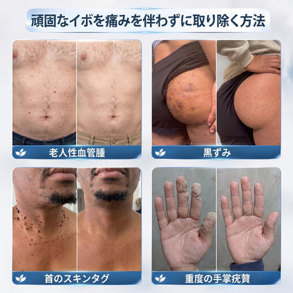 ✨追加ケアがお得！30%OFF💕 Hiskin® タグ＆スポットイレーサー🪄