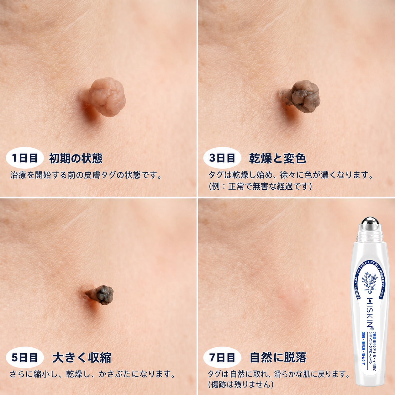 ✨追加ケアがお得！30%OFF💕 Hiskin® タグ＆スポットイレーサー🪄