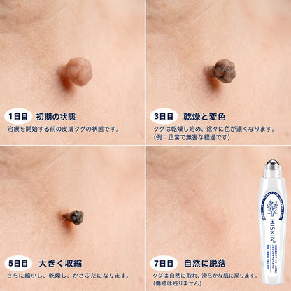 ✨追加ケアがお得！30%OFF💕 Hiskin® タグ＆スポットイレーサー🪄